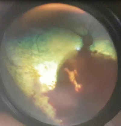 KTS Hypertensive Retinopathie