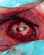 Intraoperatives Bild Hemilaminektomie