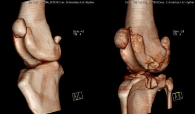 Arthrose Knie Vergleich