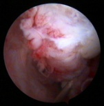 169w  Arthro Biceps