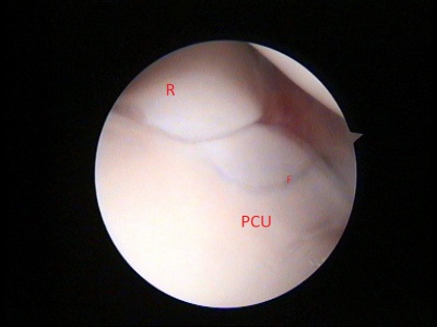 Abb 6 Arthro Fcp