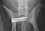 189w  Sacrum2postopap