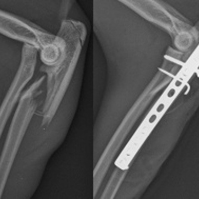 Katze mit einer speziellen Form des Knochenbruchs am Unterarm (Monteggia-Fraktur) vor und nach der Operation